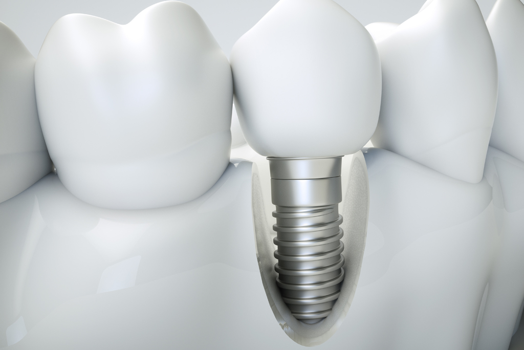 dental implants model.