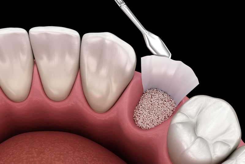 socket preservation graphic