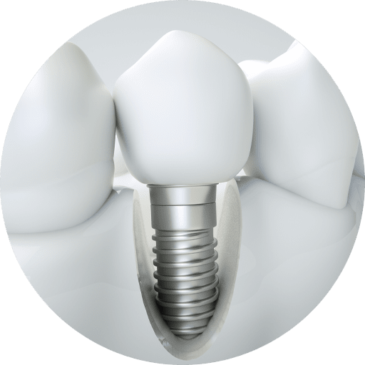 Exactly How Are All-On-X Dental Implants In Oregon City, OR Placed?