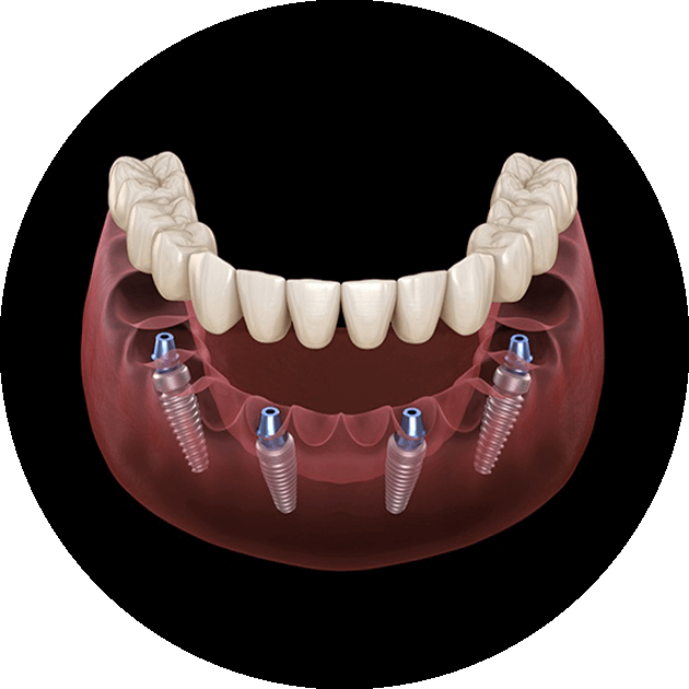 full mouth dental implants