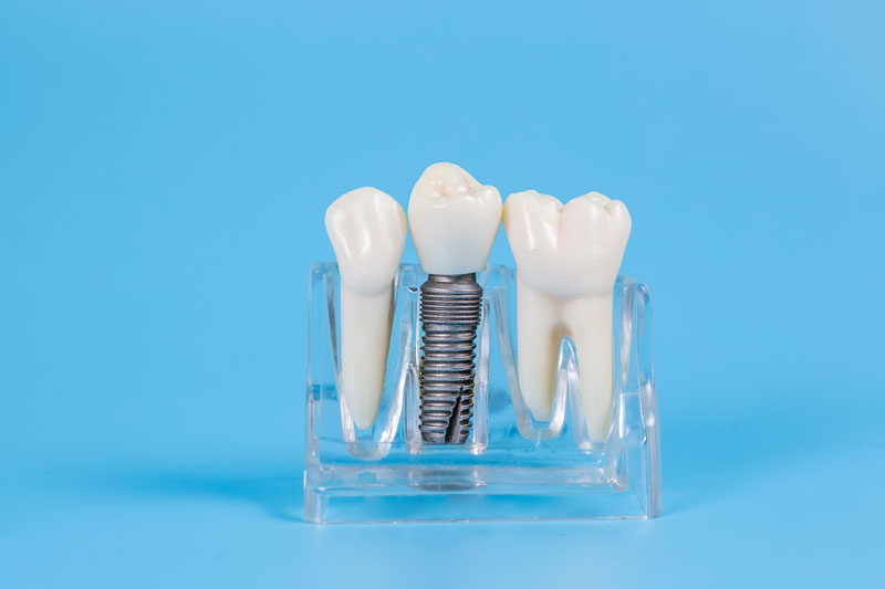 What Are The Steps To Getting Dental Implants?