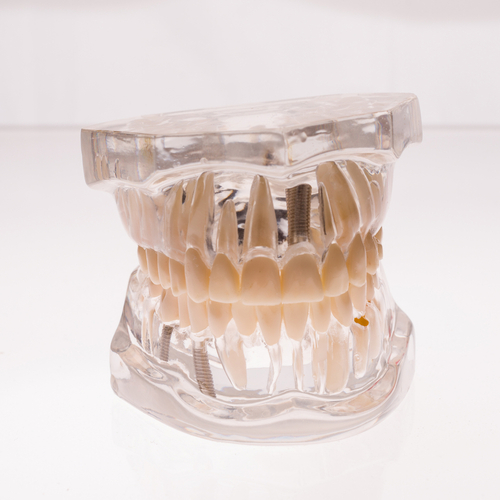 What Are My Dental Implant Options In Oregon City, OR?