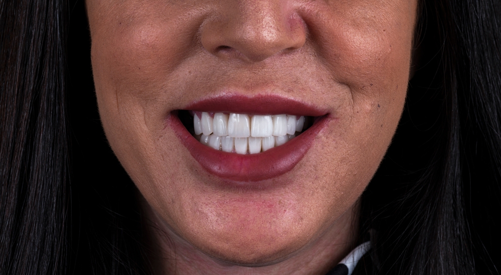 What Is The Smile Revolution 1-Day Implant Solution In Oregon City, OR?