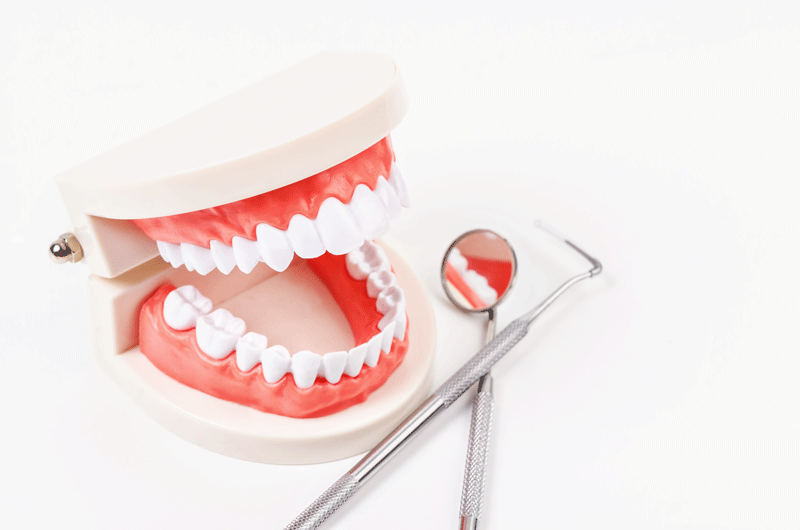What Are Full Mouth Dental Implants In Oregon City, OR?
