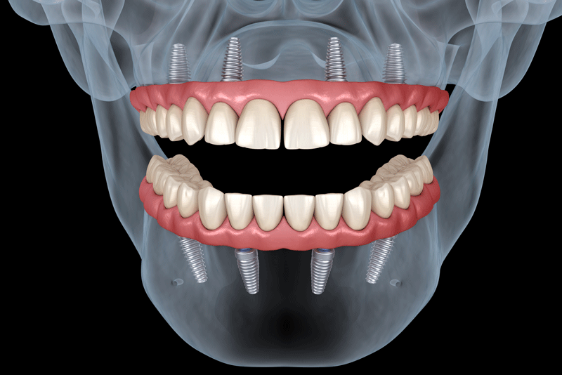 a black and white x-ray image of a patients face, highlighting in color the all-on-4 dental implants that are in their mouth.
