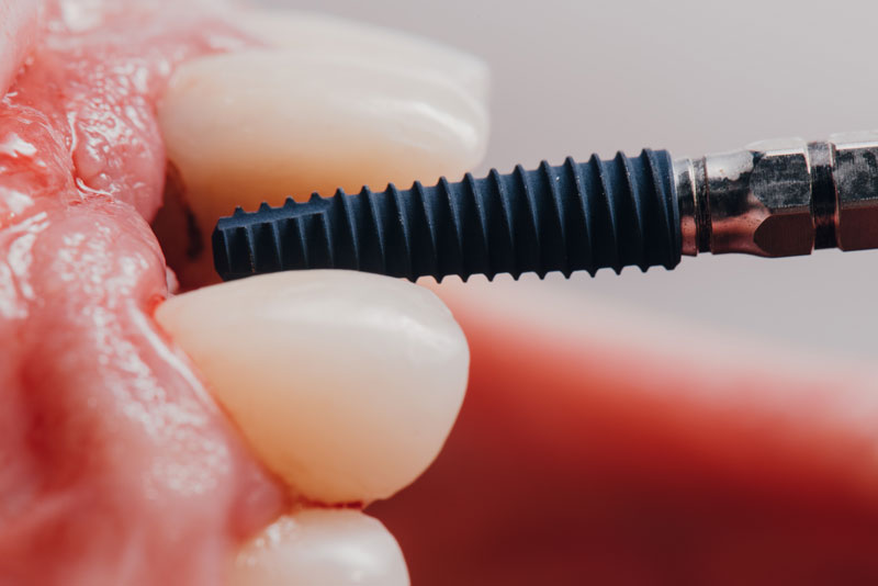 Are There Reasons Bone Grafting Should Be Done Before A Dental Implant Procedure In Oregon City, OR?