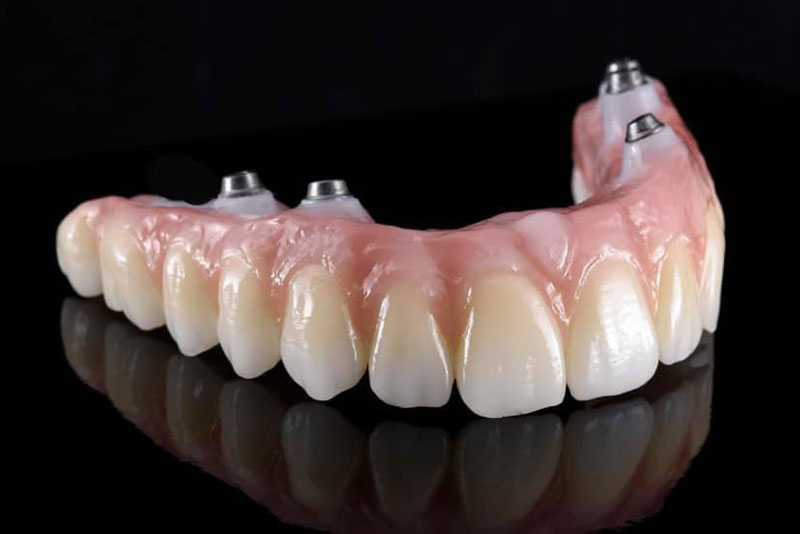 a top full arch model of a zirconia dental implant bridge.