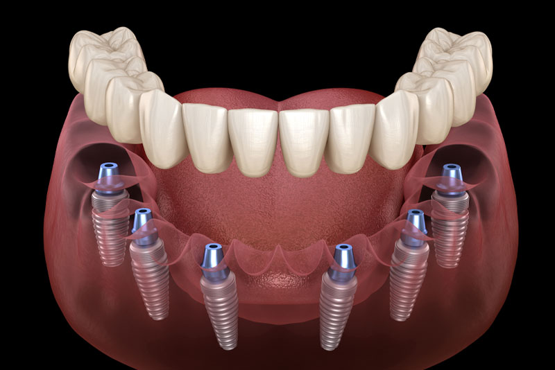 a full mouth dental implant model that can be used to show patients other additional procedures they need before they get their full mouth dental implants placed.