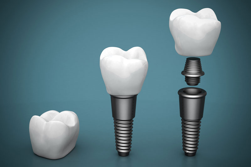 What Are The Parts That Make Up A Dental Implant In Oregon City, OR?