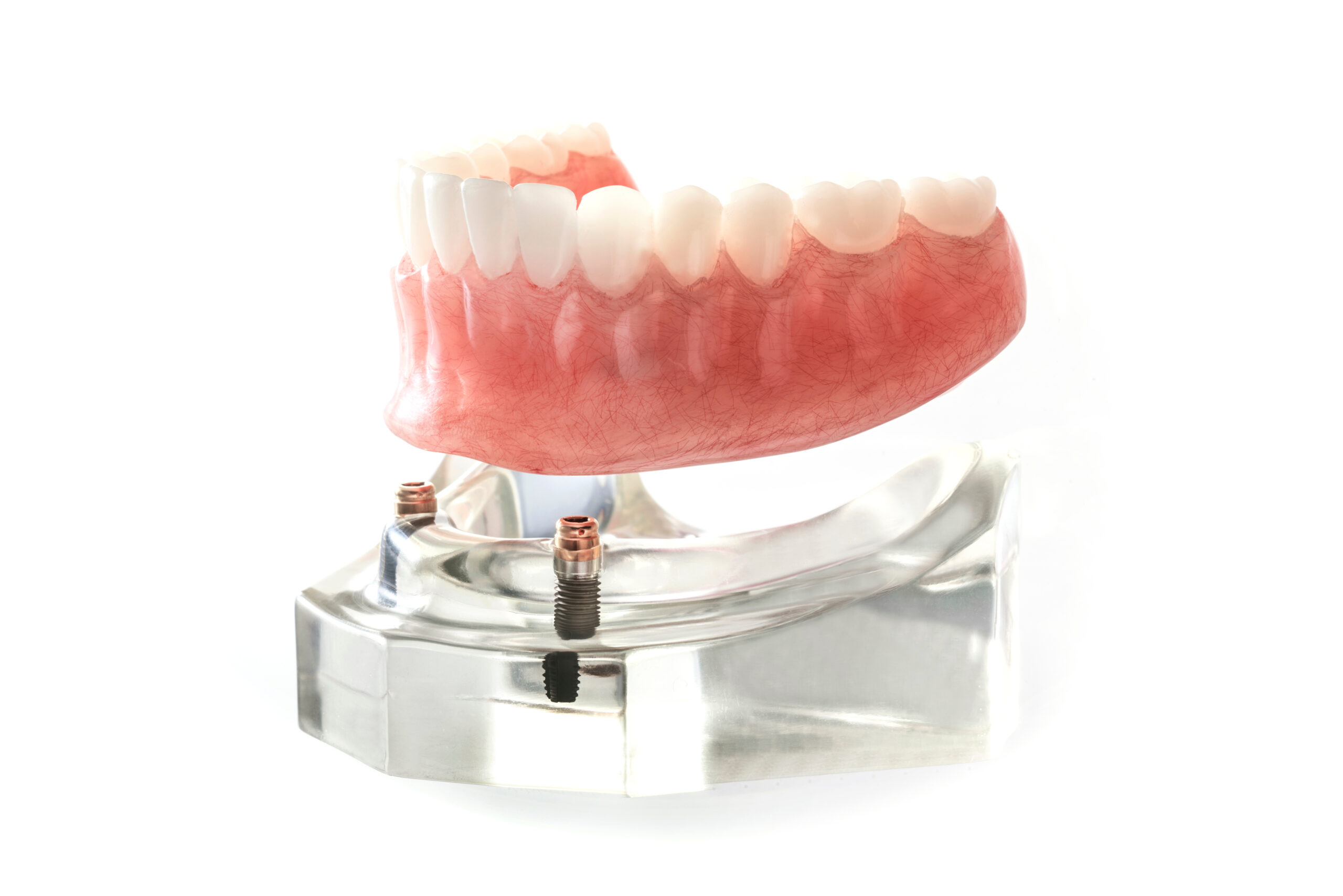 an image of implant supported dentures.