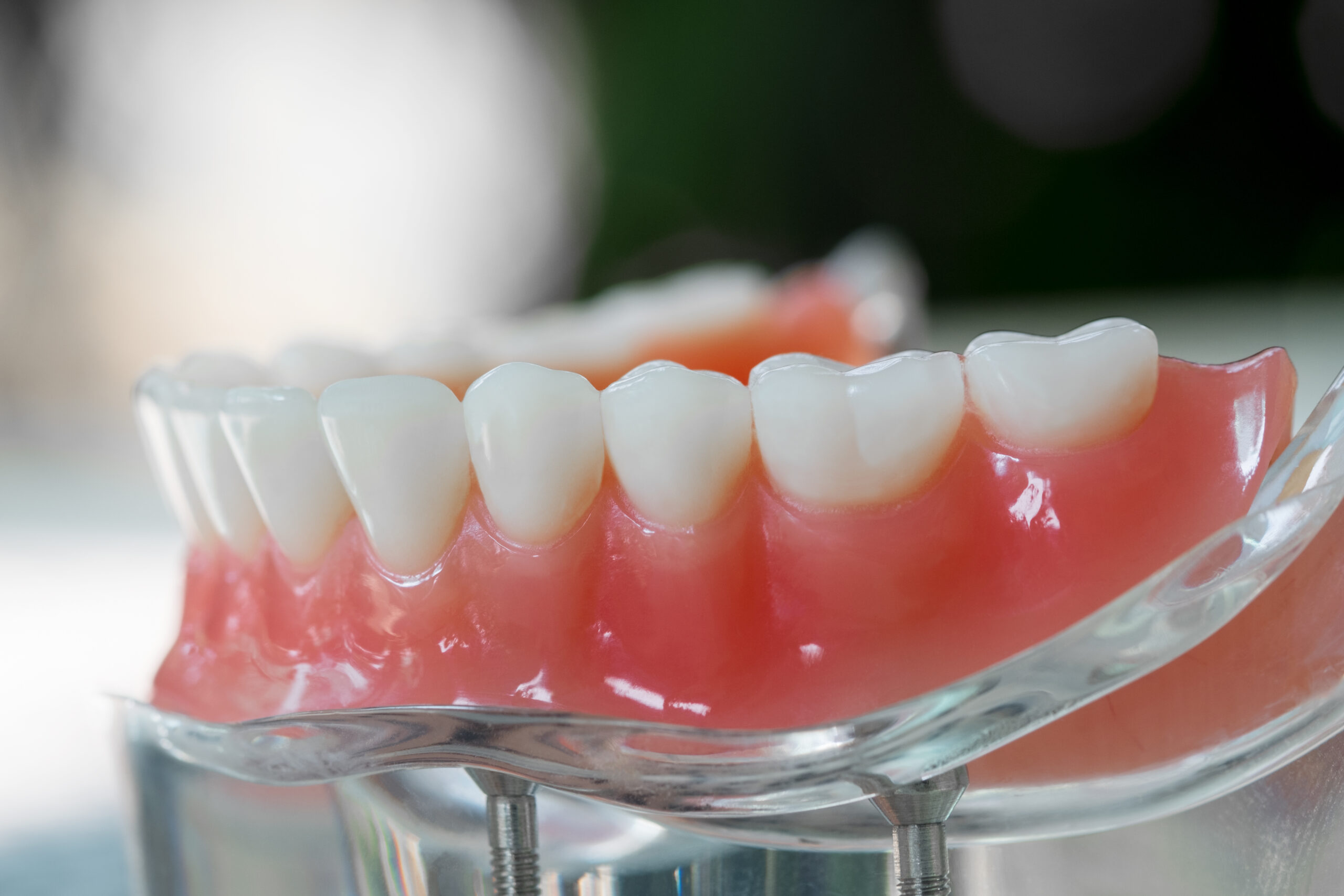 Teeth model showing an implant crown bridge model/ dental demonstration teeth study teach model.