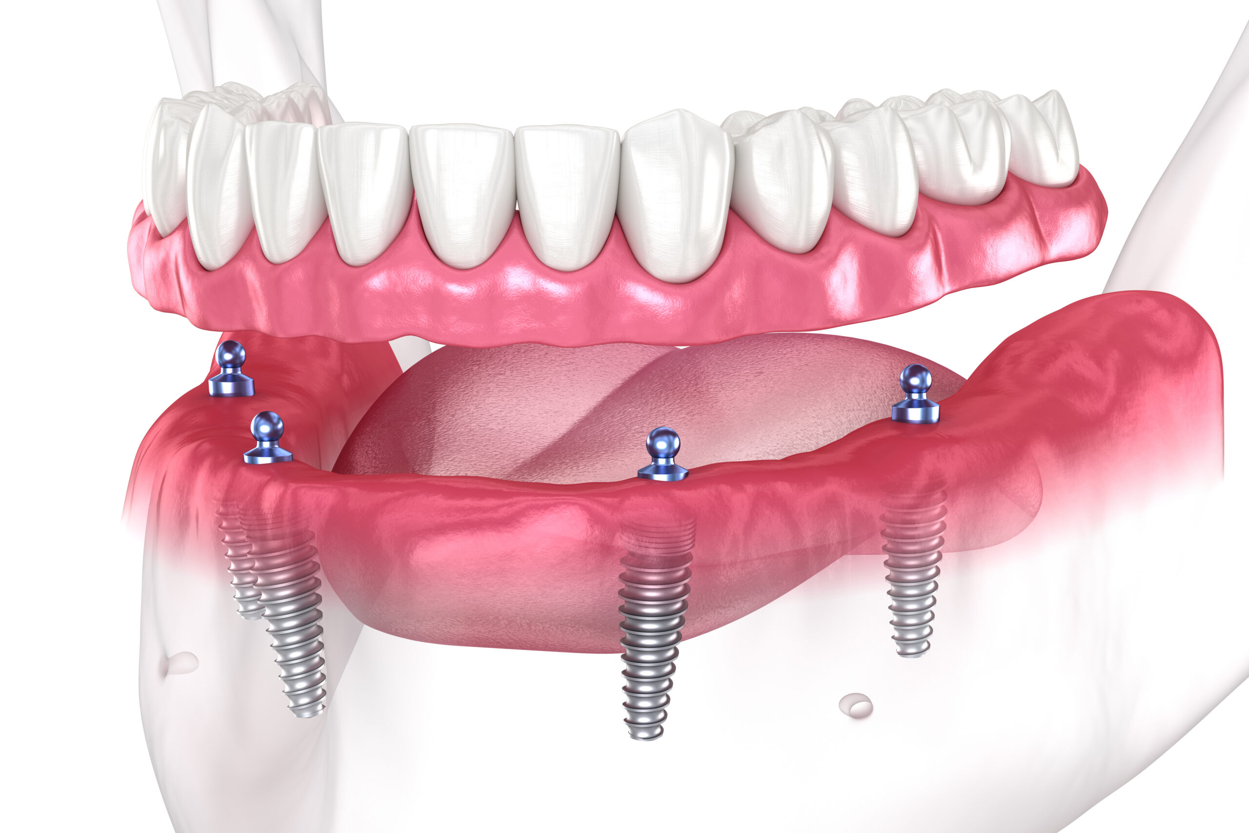 Are There Benefits That Come From Getting Treated With Full Mouth Dental Implants In Oregon City, OR?