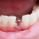 close up shot of a patient’s mouth with a single implant