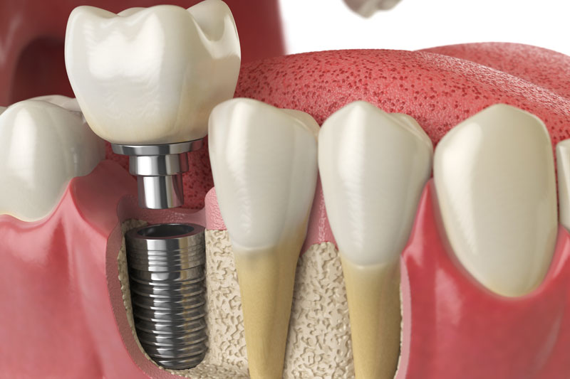 dental implant being placed into a tooth side mouth illustration with cut away