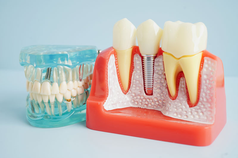 The Complete Guide to Dental Implants in Woodburn, OR