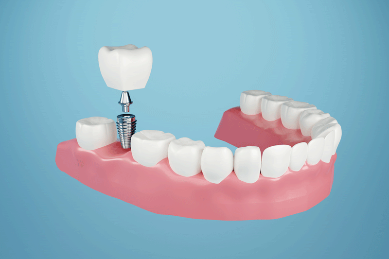 Uncovering the Mystery: The In-depth Guide to Dental Implants