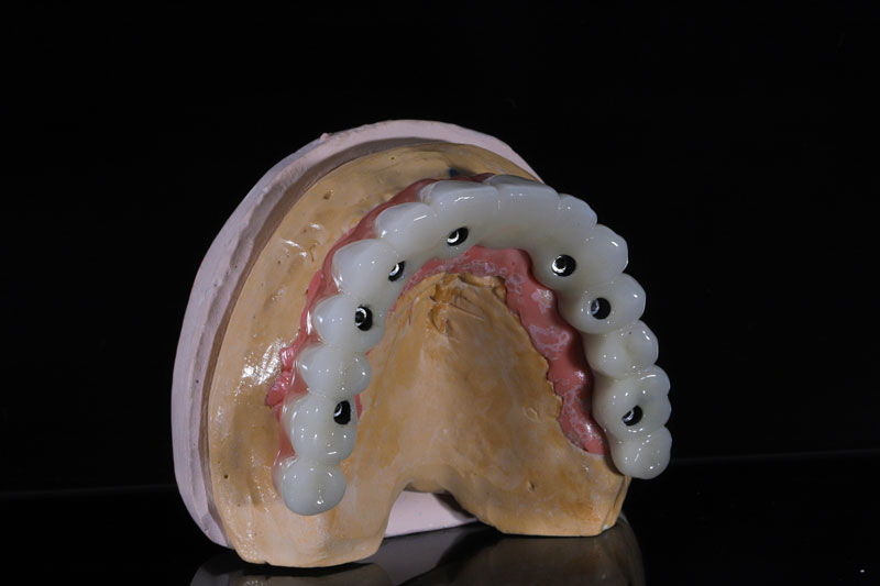 Mastering Full Arch Dental Implants in Portland | Trusted Insights With Endodontist Dr. Raleigh Pioch