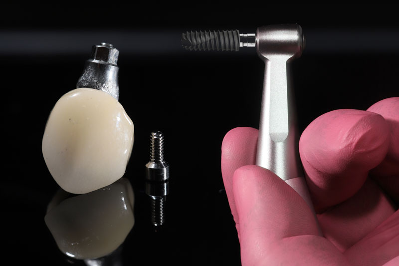 Understanding the Process & Importance of Dental Implants in Clackamas, OR