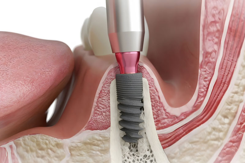 Unraveling the Magic of Dental Implants in Sunnyside, OR | Dr. Raleigh Pioch