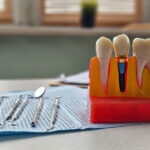 Dental implant, artificial tooth roots into jaw, root canal of dental treatment, gum disease, teeth model for dentist