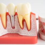 a single dental implant with a full arch of teeth next to it