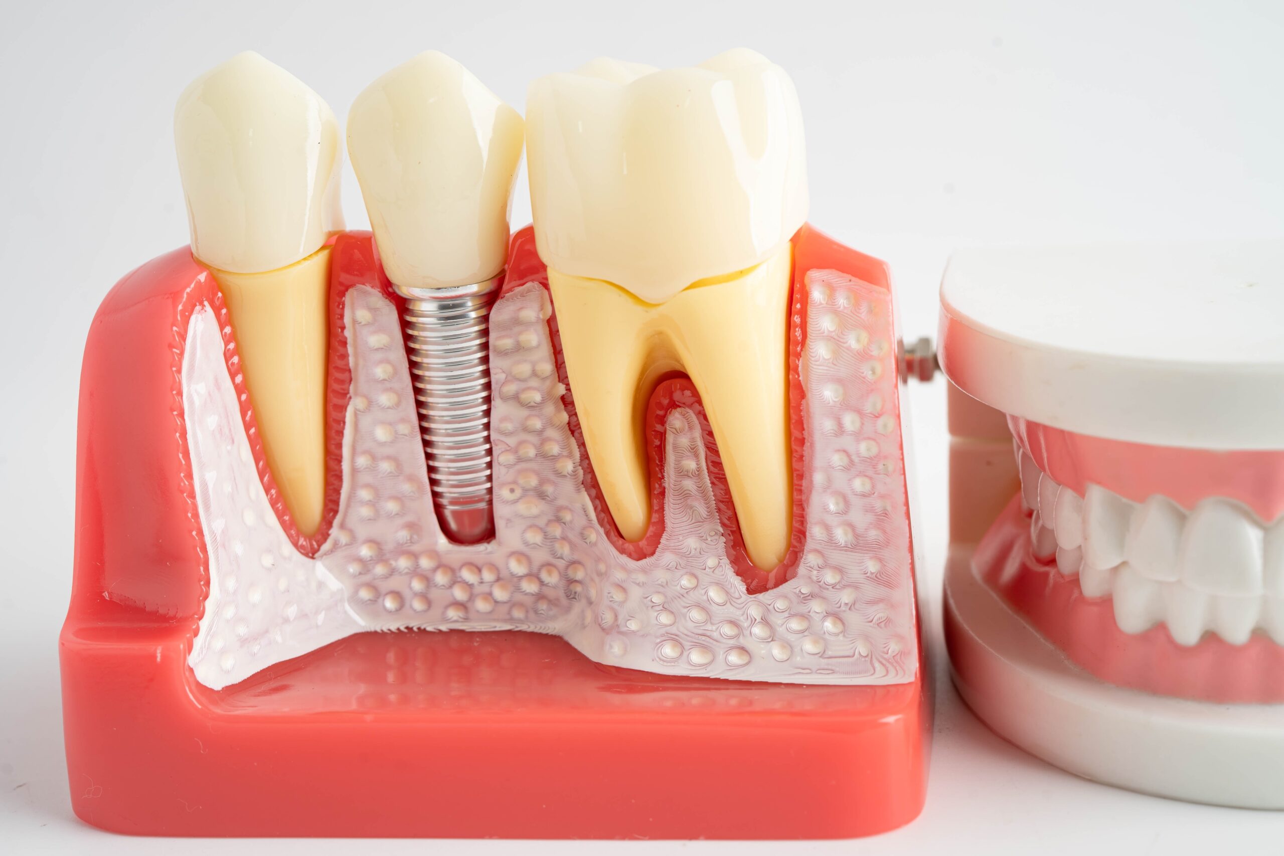 Enhancing Smiles: Denture Implants in Portland, OR and Endodontic Care